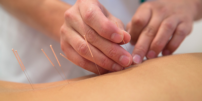 Medical Acupuncture